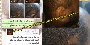 ام ريتاج لمعالجة الصلع والثعلبة